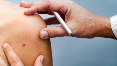 Tumore alla pelle: la diagnosi precoce è fondamentale